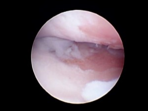 Outerbridge grade IV αλλοιώσεις στην άρθρωση του αγκώνα